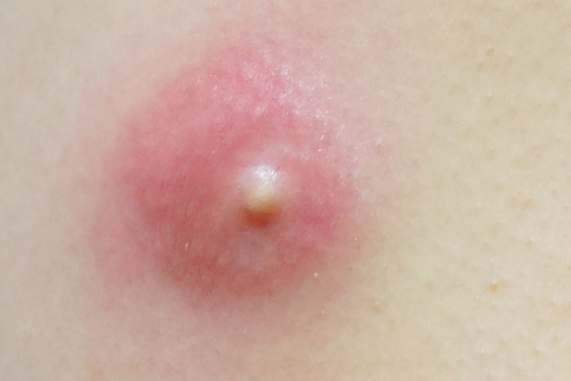 静岡市の形成外科で患者説明に利用している、感染した粉瘤の写真。皮膚直下にしこりがあり、表面皮膚は発赤あり。