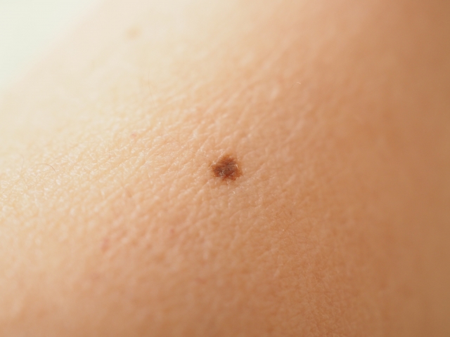 静岡市の形成外科で患者説明に利用している、色素性母斑の写真。境界明瞭な小さな黒褐色斑。