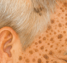 静岡市の形成外科で患者説明に利用している、脂漏性角化症（老人性イボ）のイラスト。こめかみに黒褐色の皮膚結節が多発している。