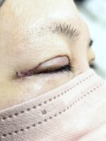 静岡市の形成外科で患者説明に利用している、眼瞼下垂手術後の創部の写真。二重の線に合わせた傷があり、腫れが残っている。