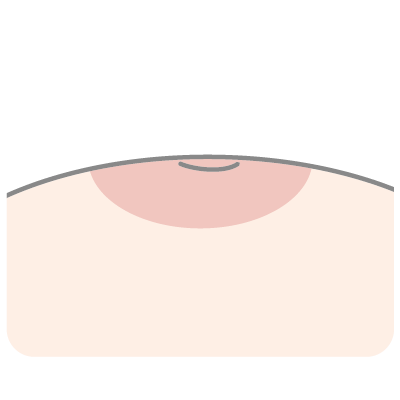静岡市の形成外科で患者説明に利用している、陥没乳頭のイラスト。乳頭が乳輪に埋まっている